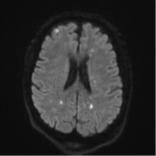 Cerebral embolic infarcts (embolic shower) (Radiopaedia 57395-64342 Axial DWI 59).png