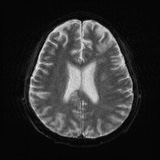 Cerebral embolic infarcts (embolic shower) (Radiopaedia 72391-82921 Axial DWI 19).jpg