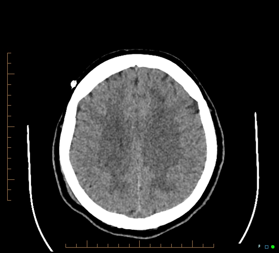 File:Cerebral fat embolism (Radiopaedia 85521-101220 Axial non-contrast 43).jpg