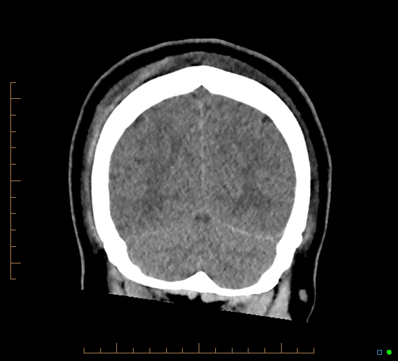 Cerebral fat embolism (Radiopaedia 85521-101224 Coronal non-contrast 51).jpg
