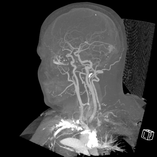 File:Cerebral hemorrhage secondary to arteriovenous malformation (Radiopaedia 33497-34571 A 7).png