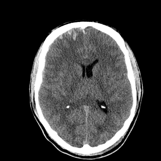 File:Cerebral hemorrhagic contusions- temporal evolution (Radiopaedia 40224-42753 Axial non-contrast 18).png