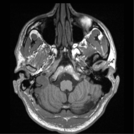 Cerebral hemorrhagic contusions- temporal evolution (Radiopaedia 40224-42757 Axial T1 13).png