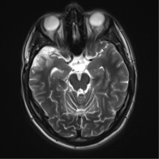 File:Cerebral hemorrhagic contusions- temporal evolution (Radiopaedia 40224-42757 Axial T2 8).png
