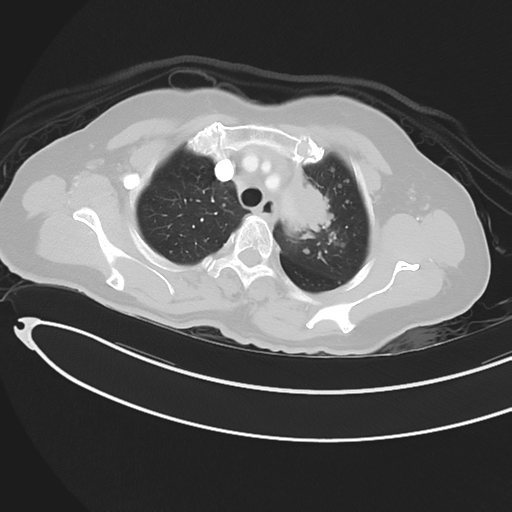 Cerebral metastases (Radiopaedia 33041-34055 Axial lung window 14).png