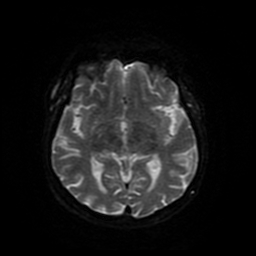 Cerebral metastases - melanoma (Radiopaedia 80972-94522 Axial DWI 79).jpg