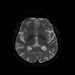 Cerebral metastases - melanoma (Radiopaedia 80972-94522 Axial DWI 80).jpg