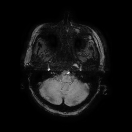 Cerebral metastases - melanoma (Radiopaedia 80972-94522 Axial SWI 19).jpg