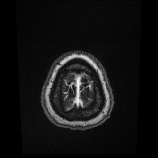 Cerebral metastases - melanoma (Radiopaedia 80972-94522 Axial T1 C+ 86).jpg
