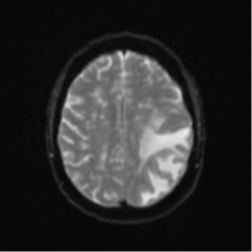 Cerebral metastasis (Radiopaedia 46744-51248 Axial DWI 20).png