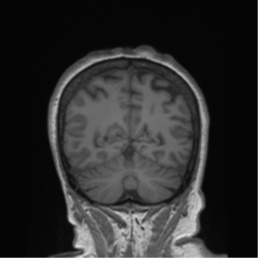 Cerebral metastasis to basal ganglia (Radiopaedia 81568-95413 Coronal T1 3).png
