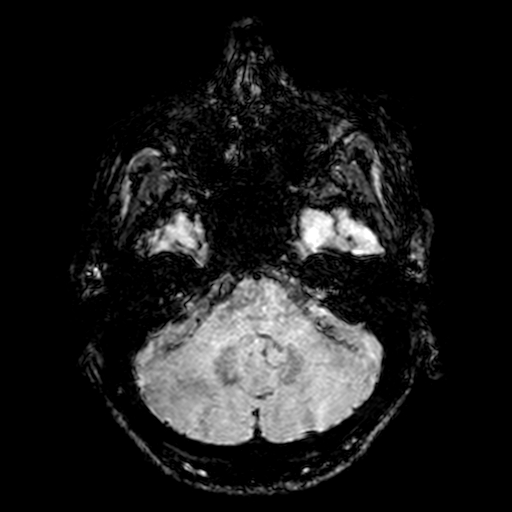 Cerebral parenchymal arteriovenous malformation (Radiopaedia 27280-27456 Axial SWI 15).jpg