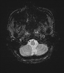 File:Cerebral toxoplasmosis (Radiopaedia 43956-47461 Axial SWI 3).jpg