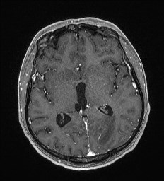 Cerebral toxoplasmosis (Radiopaedia 43956-47461 Axial T1 C+ 36).jpg