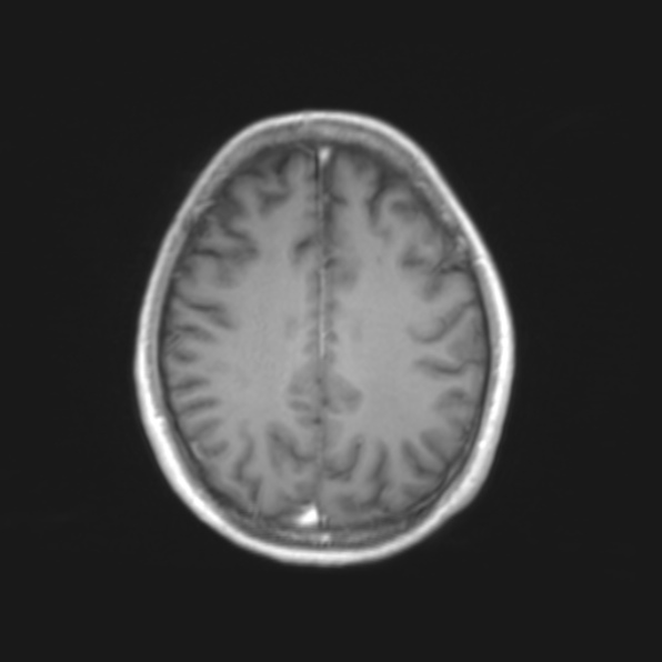 File:Cerebral toxoplasmosis (Radiopaedia 53993-61435 Axial T1 17).jpg