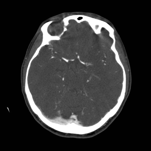 Cerebral venous sinus thrombosis (Radiopaedia 40619-43227 A 92).jpg
