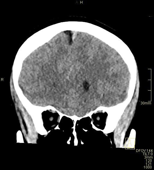 Cerebral venous sinus thrombosis (Radiopaedia 91329-108965 Coronal non-contrast 16).jpg