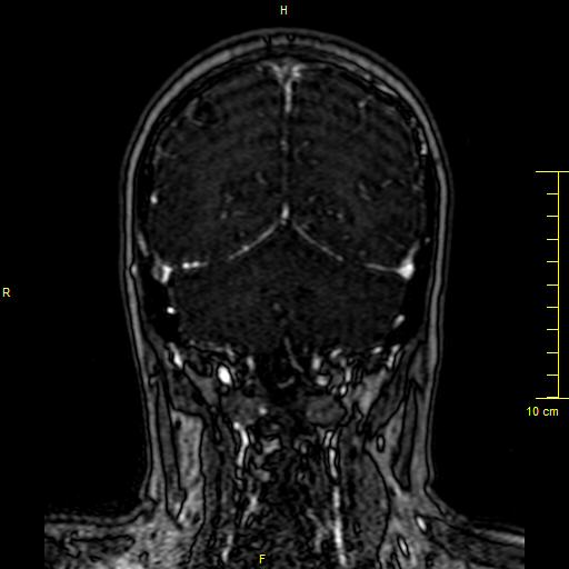 Cerebral venous thrombosis (Radiopaedia 23288-23351 MRV 126).JPG