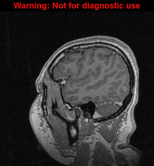 Cerebral venous thrombosis (Radiopaedia 37224-39208 Sagittal T1 C+ 123).jpg
