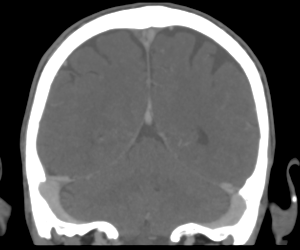 File:Cerebral venous thrombosis (Radiopaedia 38392-40467 Coronal CTA-Venogram 45).png