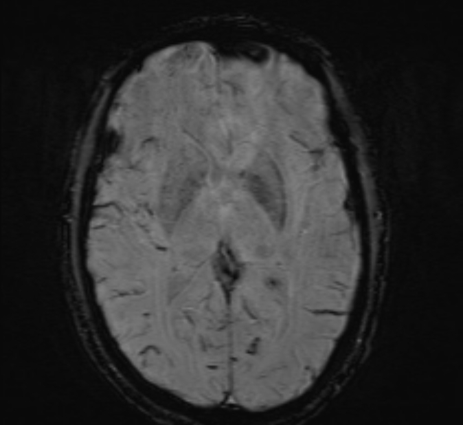 Cerebral venous thrombosis (Radiopaedia 71207-81504 Axial SWI 27).jpg