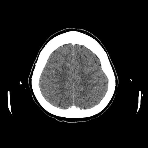 Cerebral venous thrombosis with venous hemorrhagic infarct (Radiopaedia 90354-107660 Axial with contrast 133).jpg