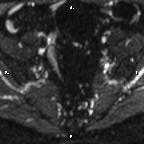 Cervical adenocarcinoma (Radiopaedia 65011-73985 Axial DWI 73).jpg