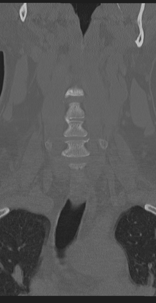 Cervical canal stenosis due to ossification of the posterior longitudinal ligament (Radiopaedia 47260-51823 Coronal bone window 12).png