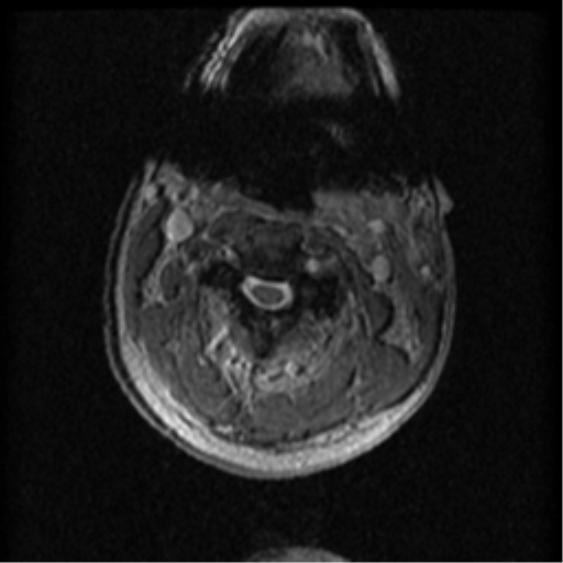 File:Cervical canal stenosis with cord compression (Radiopaedia 34114-35374 Axial Gradient Echo 73).png