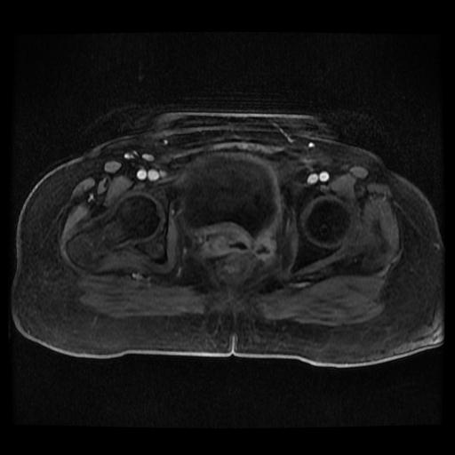 Cervical carcinoma (Radiopaedia 70924-81132 Axial T1 C+ fat sat 215).jpg
