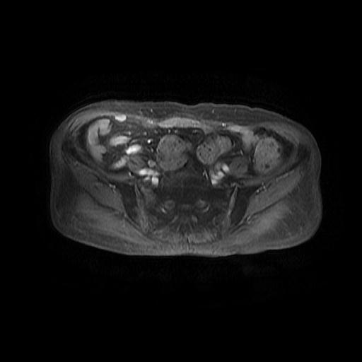 File:Cervical carcinoma (Radiopaedia 78847-91705 Axial T1 C+ fat sat 3).jpg