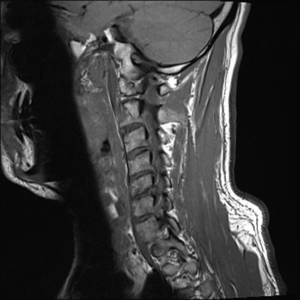 File:Cervical disc extrusion (Radiopaedia 53950-60077 Sagittal T1 6).jpg