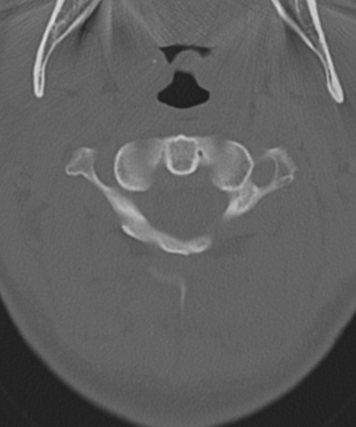 Cervical intercalary bone (Radiopaedia 35211-36748 Axial bone window 15).png