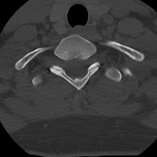 Cervical schwannoma (Radiopaedia 57979-64974 Axial bone window 42).png