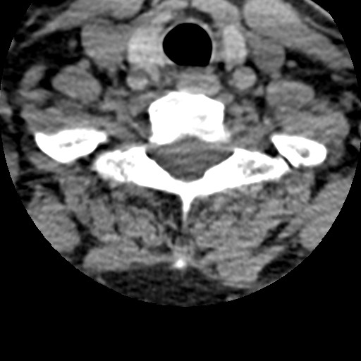 File:Cervical spinal neurofibroma in a patient with NF1 (Radiopaedia 58344-65464 Axial non-contrast 64).jpg