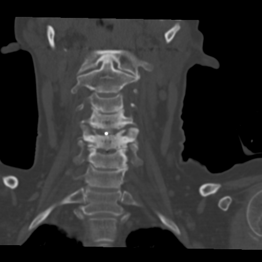File:Cervical spine ACDF loosening (Radiopaedia 48998-54070 Axial bone window 1).png