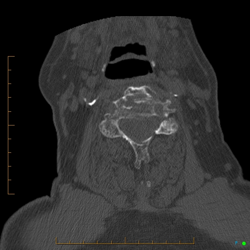 Cervical spine fracture - ankylosing spondylitis (Radiopaedia 76835-88706 Axial bone window 107).jpg