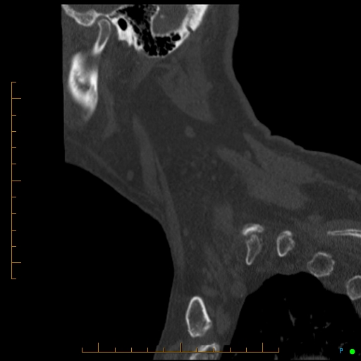 Cervical spine fracture - ankylosing spondylitis (Radiopaedia 76835-88706 Sagittal bone window 13).jpg