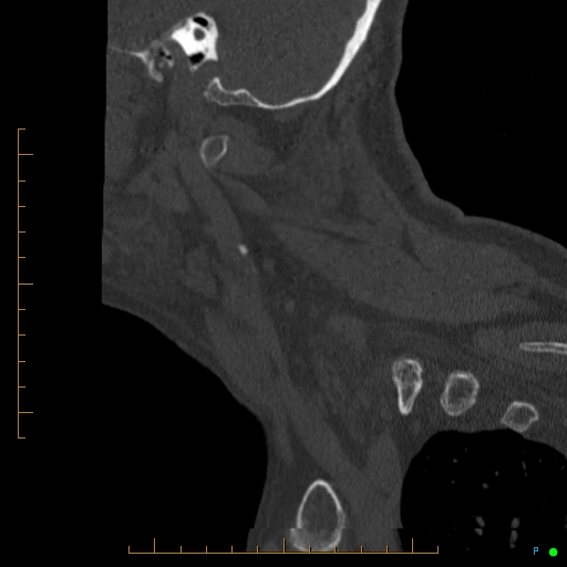 Cervical spine fracture - ankylosing spondylitis (Radiopaedia 76835-88706 Sagittal bone window 95).jpg