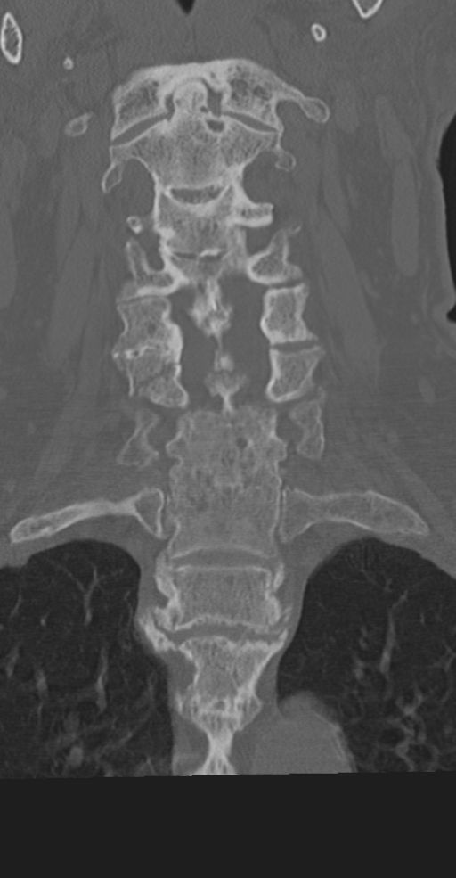 Cervical spine fracture in the setting of ankylosis (Radiopaedia 37038-38715 Coronal bone window 32).png