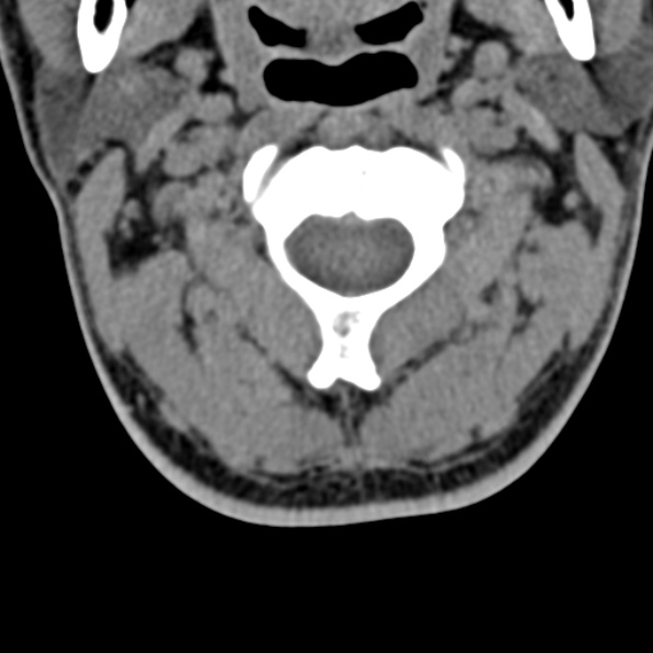 Cervical spondylodiscitis (Radiopaedia 28057-29489 Axial non-contrast 23).jpg