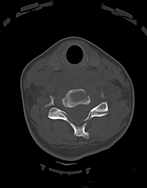 Cervical tuberculous spondylitis (Radiopaedia 39149-41365 Axial bone window 33).png