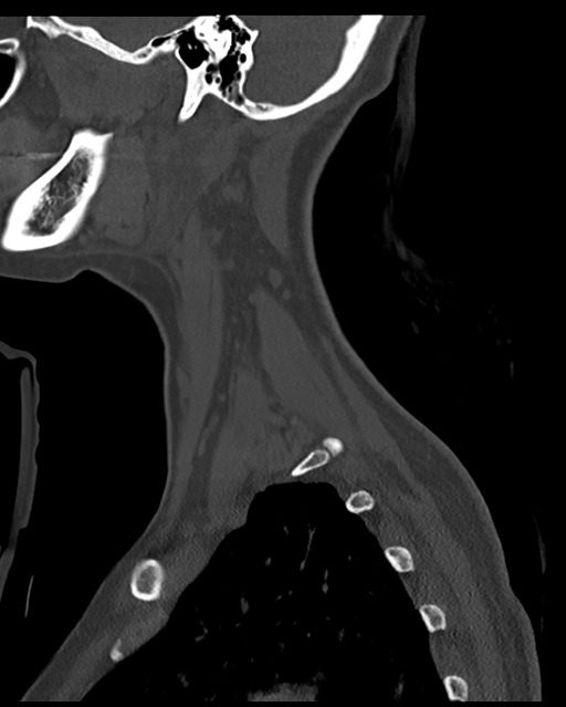 Cervical tuberculous spondylitis (Radiopaedia 39149-41365 Sagittal bone window 11).png