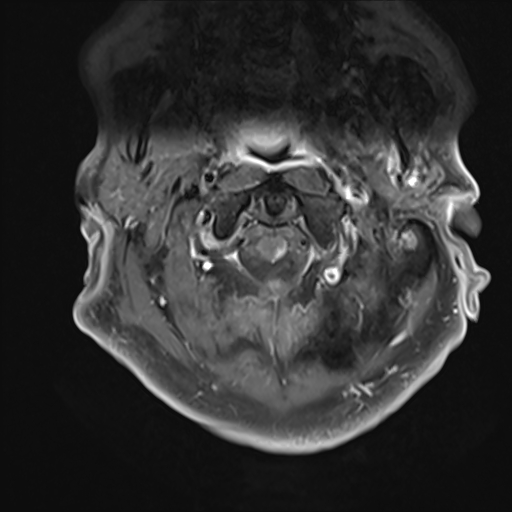 File:Cervical tumor-like myelopathy due to Type V dAVF (Radiopaedia 82461-96604 Axial T1 C+ fat sat 4).jpg