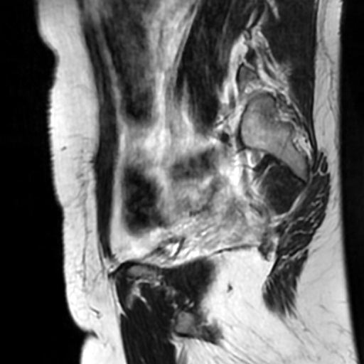 File:Cesarian section scar endometriosis (Radiopaedia 66520-75799 Sagittal T2 8).jpg