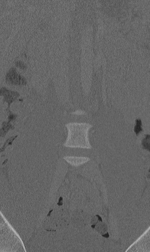 Chance fracture (Radiopaedia 40360-42912 Coronal bone window 12).png