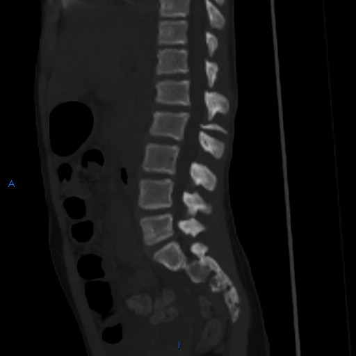 File:Chance fracture with duodenal and pancreatic lacerations (Radiopaedia 43477-50042 Sagittal bone window 10).jpg