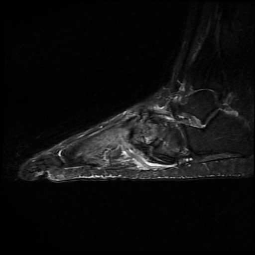 File:Charcot arthropathy (Radiopaedia 55056-61422 Sagittal T2 fat sat 12).jpg