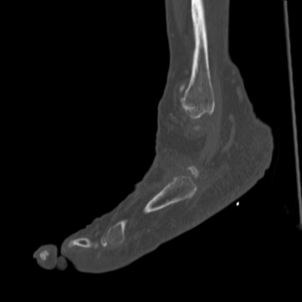 Charcot joint (Radiopaedia 36629-38194 Sagittal bone window 29).jpg