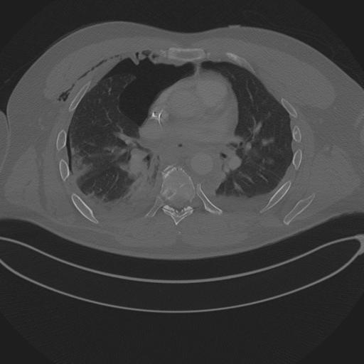 Chest multitrauma - aortic injury (Radiopaedia 34708-36147 Axial bone window 151).png